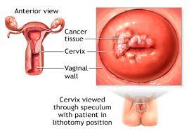 Beyond Pap Smears: Total Care Diagnostics’ Comprehensive Cervical Cancer Diagnostics